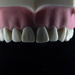 Отсутствие верхних зубов: причины, последствия, лечение
