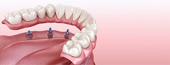Полная имплантация зубов: как восстановить целостность зубного ряда